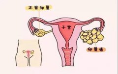 导致卵巢疾病的主要因素